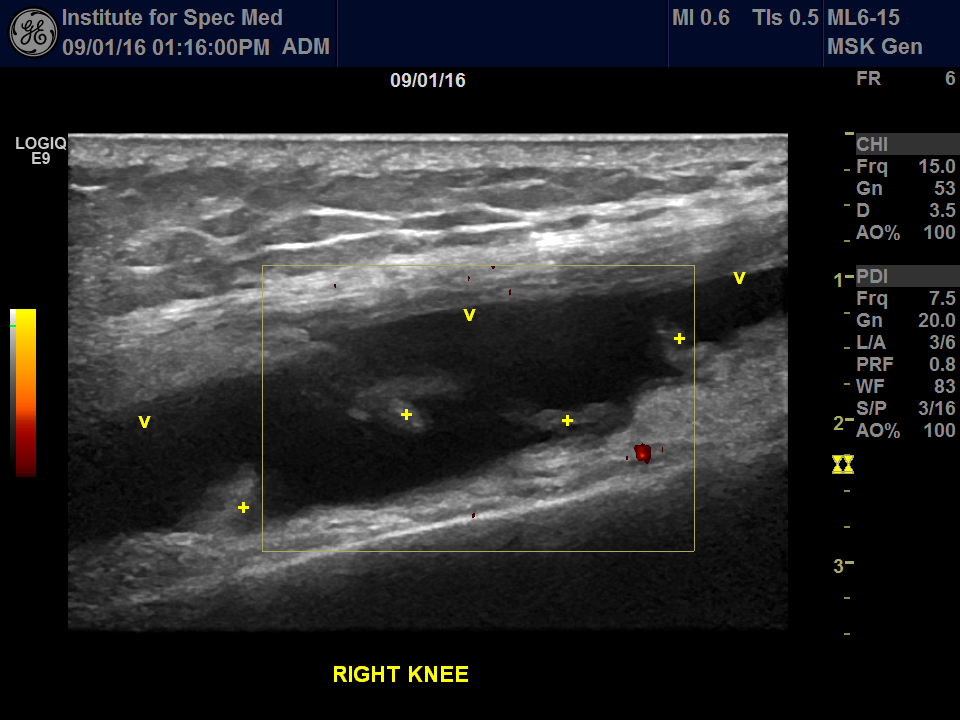 Lyme disease ultrasound of the knee