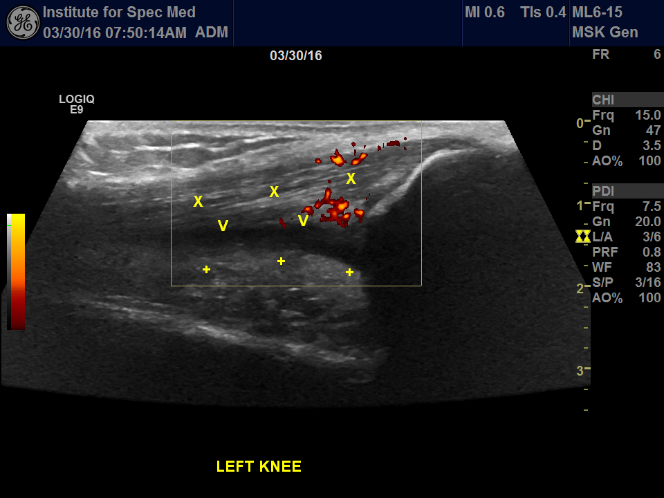 suprapatellar compartment