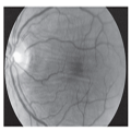 chorioretinal folds