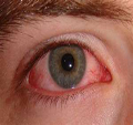 keratitis associated lyme disease