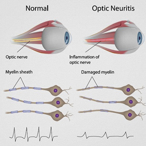 optic neuritis