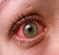 conjunctivitis