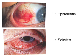 episcleritis_scleritis