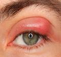 eyelid edema