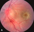 neuroretinitis image