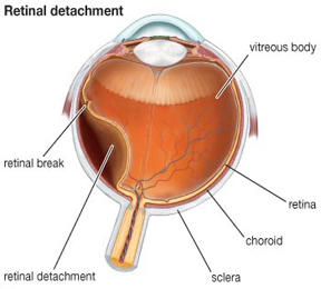 retinal detachment