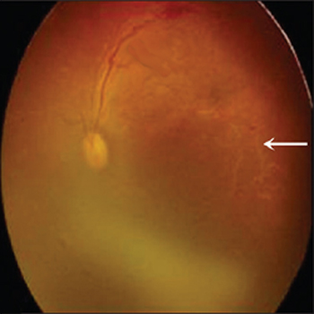 retinal vasculitis