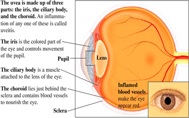 uveitis