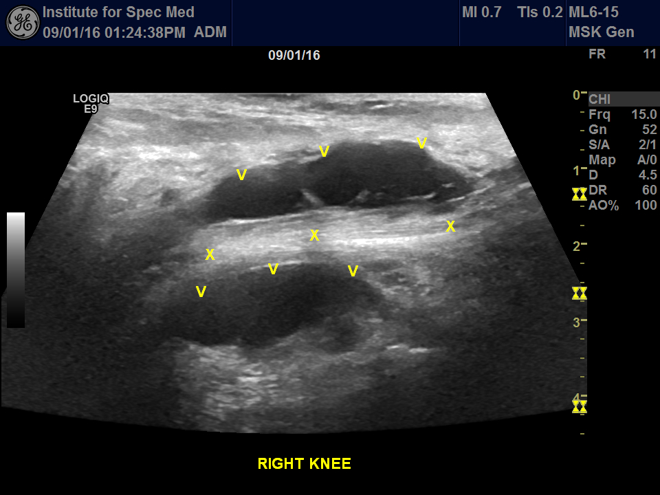 popliteal cyst from lyme disease